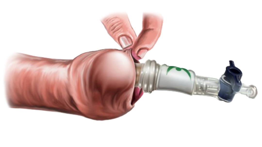 Inserting the Novoglan device