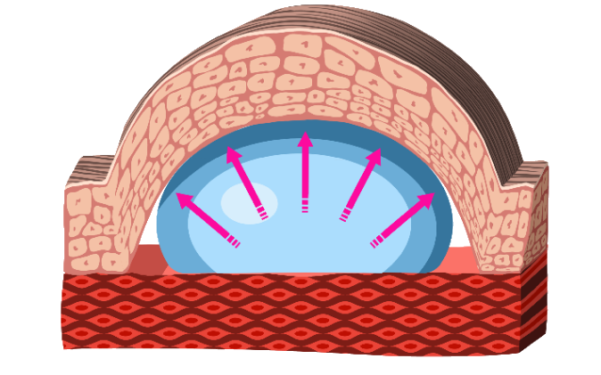 Skin stretching during Novoglan treatment