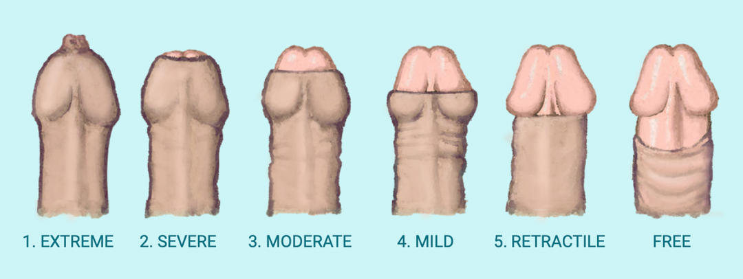 Understanding Phimosis - Recorded 'Live' Webinar Available Now.