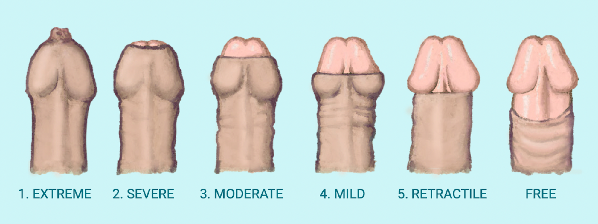 Understanding Phimosis - Recorded 'Live' Webinar Available Now.